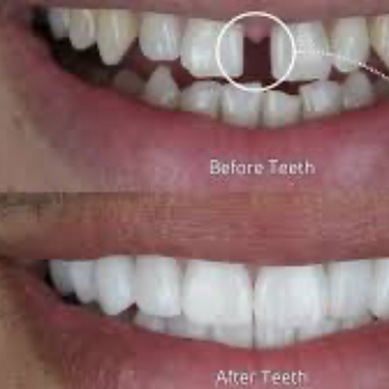 Treatment For Teeth Spacing | Dr Care Dental Hospital | Dental Clinic | Dentist | H.NO-8-7-91/17/1, SREE HOMES, Nagarjuna Sagar Rd, Padmavathi Nagar, Hasthinapuram South, Hastinapuram,