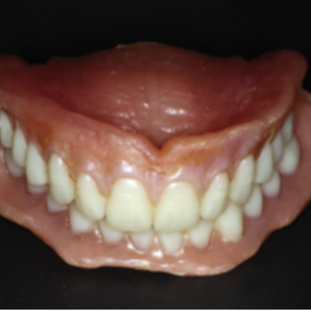 DENTURES | AADANSHA DENTAL CARE | Aarohi Galleria, C108, Arohi Crest Rd, Aaryan Gloria, South Bopal, Bopal, Ahmedabad, Gujarat 380058, India