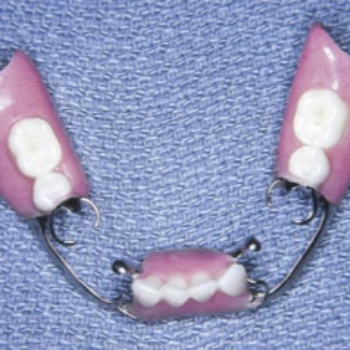 PARTIAL DENTURE AADANSHA DENTAL CARE Aarohi Galleria, C108, Arohi Crest Rd, Aaryan Gloria, South Bopal, Bopal, Ahmedabad, Gujarat 380058, India