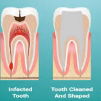 ROOT CANAL TREATMENT AADANSHA DENTAL CARE Aarohi Galleria, C108, Arohi Crest Rd, Aaryan Gloria, South Bopal, Bopal, Ahmedabad, Gujarat 380058, India