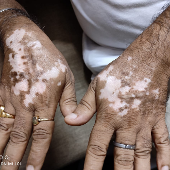 Vitiligo Dr Amit Kumar Gupta, Homeopathic Doctor Ghaziabad, Uttar Pradesh 201010, India