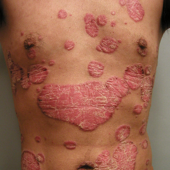 Psoriasis Dr Amit Kumar Gupta, Homeopathic Doctor Ghaziabad, Uttar Pradesh 201010, India