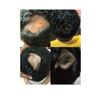 Alopecia Dr Amit Kumar Gupta, Homeopathic Doctor Ghaziabad, Uttar Pradesh 201010, India
