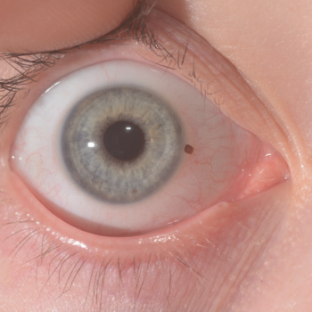 Foreign body at Vision eye clinic - Eye Clinic and Optician, Amarpur