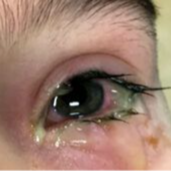 Bacterial infection at Vision eye clinic - Eye Clinic and Optician, Amarpur