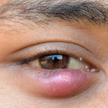 Stye in eye at Vision eye clinic - Eye Clinic and Optician, Amarpur
