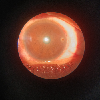 Foreign Body - Expert Eye Care in Jehanabad at Vision eye clinic - Eye Clinic and Optician, Amarpur