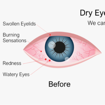 Dry Eyes Treatment in Patna Gaya Road, Jehanabad at Vision eye clinic - Eye Clinic and Optician, Amarpur