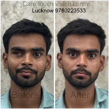 Eye Surgery Result (Before & After) CARE TOUCH VISION CENTRE 439B 202  MALIHABAD ROAD  THAKUR GANJ