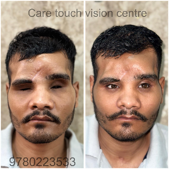 Best Eye Surgery in Lucknow – Before & After Results CARE TOUCH VISION CENTRE 439B 202  MALIHABAD ROAD  THAKUR GANJ