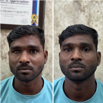 Successful Eye Surgery Transformation CARE TOUCH VISION CENTRE 439B 202  MALIHABAD ROAD  THAKUR GANJ