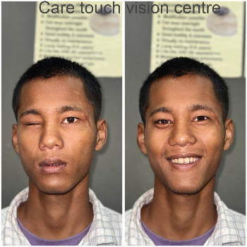 Expert Eye Surgery Care – Visible Results CARE TOUCH VISION CENTRE 439B 202  MALIHABAD ROAD  THAKUR GANJ