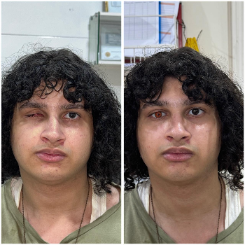 Eyelid Treatment / Eye Opening Surgery – Before & After CARE TOUCH VISION CENTRE 439B 202  MALIHABAD ROAD  THAKUR GANJ