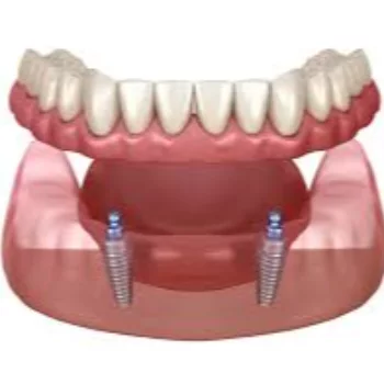 Implant supported denture in Patna — Oro Dental Clinic Oro Dental Clinic Sumitra Complex, Above Union Bank (1st Floor Beside Punjab National Bank, Opp. ICICI Bank Ashiana-Digha, 25, Main - Road, Ramnagri, Ram Nagari, Rukanpura, Patna, Bihar 800025, India