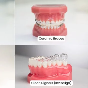 Fixed orthodontics service in Patna — Oro Dental Clinic Oro Dental Clinic Sumitra Complex, Above Union Bank (1st Floor Beside Punjab National Bank, Opp. ICICI Bank Ashiana-Digha, 25, Main - Road, Ramnagri, Ram Nagari, Rukanpura, Patna, Bihar 800025, India