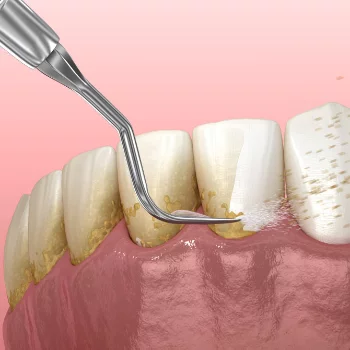 Dental scaling in Patna — Oro Dental Clinic Oro Dental Clinic Sumitra Complex, Above Union Bank (1st Floor Beside Punjab National Bank, Opp. ICICI Bank Ashiana-Digha, 25, Main - Road, Ramnagri, Ram Nagari, Rukanpura, Patna, Bihar 800025, India
