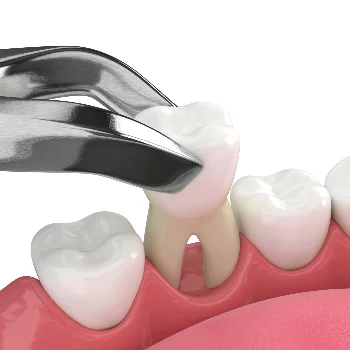 Dental Extraction in Patna — Oro Dental Clinic Oro Dental Clinic Sumitra Complex, Above Union Bank (1st Floor Beside Punjab National Bank, Opp. ICICI Bank Ashiana-Digha, 25, Main - Road, Ramnagri, Ram Nagari, Rukanpura, Patna, Bihar 800025, India