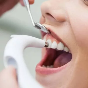Professional Teeth Cleaning & Polishing in Mumbai