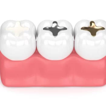 Tooth-Coloured (Composite) Fillings in Mumbai