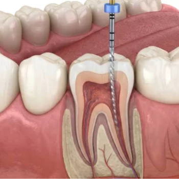 Expert Root Canal Treatment (RCT) in Mumbai