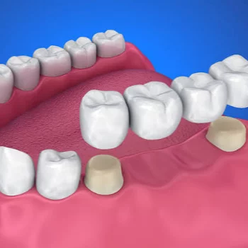 Premium Dental Crowns & Bridges in Mumbai