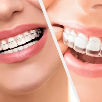Expert Orthodontist Services in Jaipur Smile Carve Dental Clinic & Facial Aesthetic Center Nandan Apartment, C 72 Sarojini Marg, C Scheme