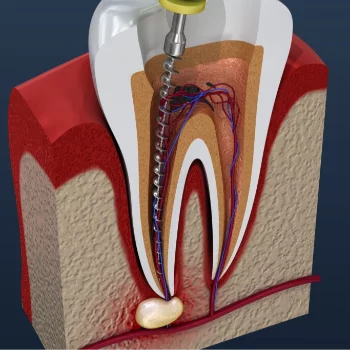 Root Canal Therapy in Jaipur Smile Carve Dental Clinic & Facial Aesthetic Center Nandan Apartment, C 72 Sarojini Marg, C Scheme