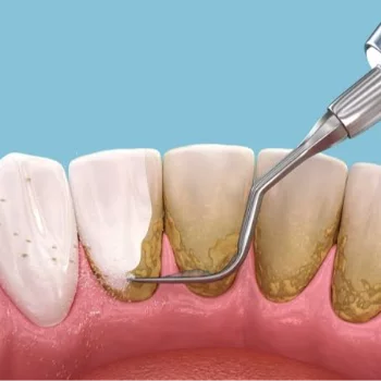 Dental Scaling and Polishing in Jaipur Smile Carve Dental Clinic & Facial Aesthetic Center Nandan Apartment, C 72 Sarojini Marg, C Scheme
