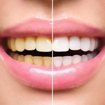Teeth Whitening in Jaipur Smile Carve Dental Clinic & Facial Aesthetic Center Nandan Apartment, C 72 Sarojini Marg, C Scheme