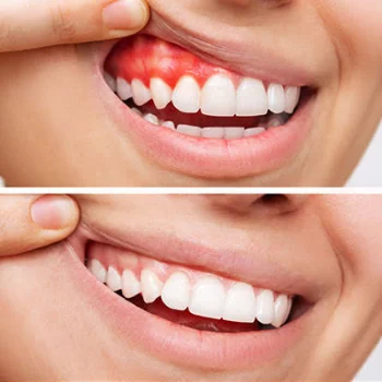 Gum Treatment Dental Clinic In C Scheme, Jaipur — Smile Carve Nandan Apartment, 201, C- 72, Sarojini Marg, Above Baristaa Cafe And House Of Beans, C Scheme, Jaipur, Rajasthan 302001
