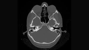 Sinus CT scan | Vision Diagnostic Center (32 Slice CT Scan & 1.5 Testa MRI Centre) | Link Road Near Aditya Bakery ,betul Mp