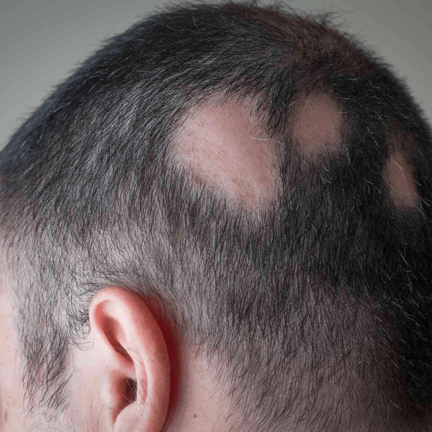 Homeopathic Treatment for Alopecia Areata | Homeo Pathy Clinic | 736 R Mahalaxmi Nagar Vijay Nagar Indore