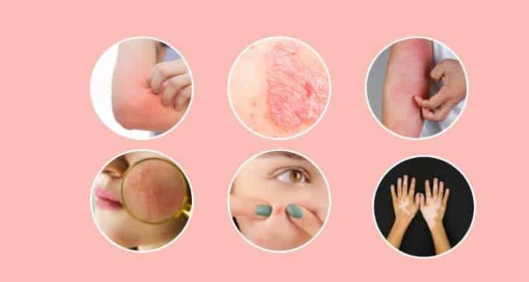 Ayurvedic Treatment for Skin Disorders | Rigved Ayurved | 66/4, Kanadia Rd, Sector A, Sanvid Nagar, Indore, Madhya Pradesh 452016, India
