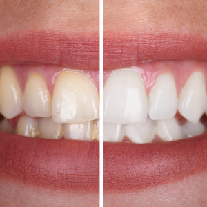 Teeth Whitening | Speciality Dental Clinic | First Floor, A Wing, A6,Fountain Head, G A, Appasaheb Kulkarni Path, Off Karve Road, Opp. Starbucks, Kothrud, Pune, Maharashtra 411038