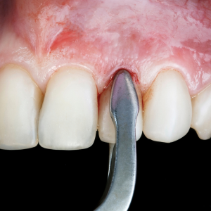 Safe and Efficient Tooth Extraction | Speciality Dental Clinic | First Floor, A Wing, A6,Fountain Head, G A, Appasaheb Kulkarni Path, Off Karve Road, Opp. Starbucks, Kothrud, Pune, Maharashtra 411038