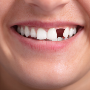 Fixed and Removable Teeth Replacement | Speciality Dental Clinic | First Floor, A Wing, A6,Fountain Head, G A, Appasaheb Kulkarni Path, Off Karve Road, Opp. Starbucks, Kothrud, Pune, Maharashtra 411038