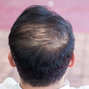 PRP Hair Loss Treatment at Skiniva Skin Clinic | SKINIVA SKIN CLINIC | Shop No 107-108,1st Floor, Astha Medicare, Road, Above HDFC Bankabrama, Below Sardardham Office, Mota Varachha, Surat, Gujarat 394105, India