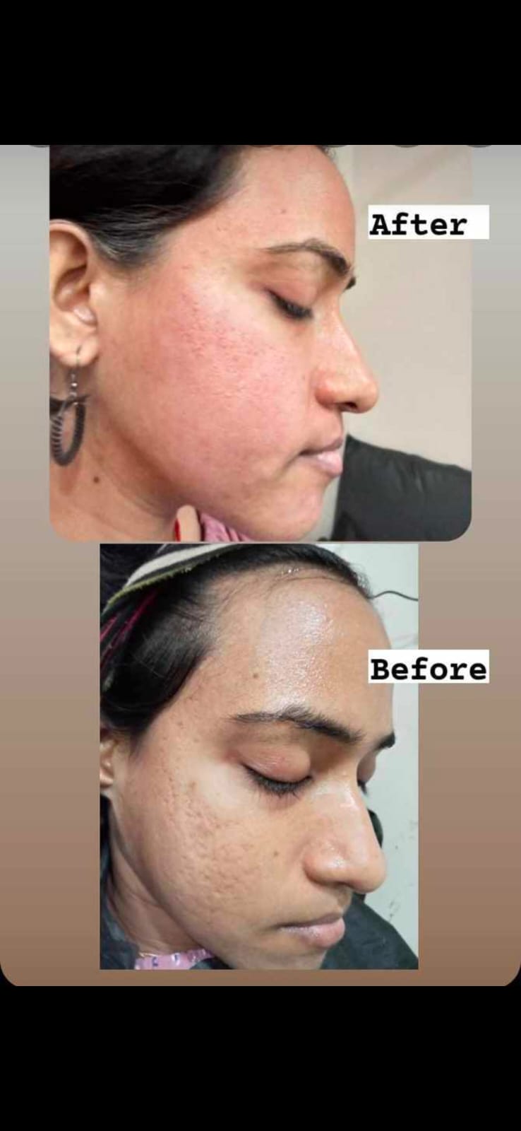 PRP Treatment The Beauty Maker 27 C Seva Sardar Nager Near Sawariya Park Geeta Bhawan Indore