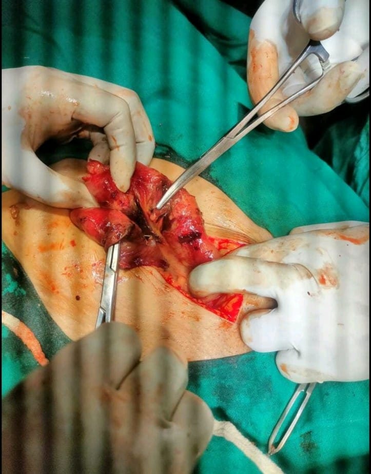 Ovarian Tumor | Jangjeet Hospital Dholpur | Kotla ,Dholpur, Rajasthan