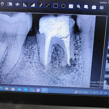 Dental Laser treatment. | Speciality Dental Clinic | First Floor, A Wing, A6,Fountain Head, G A, Appasaheb Kulkarni Path, Off Karve Road, Opp. Starbucks, Kothrud, Pune, Maharashtra 411038