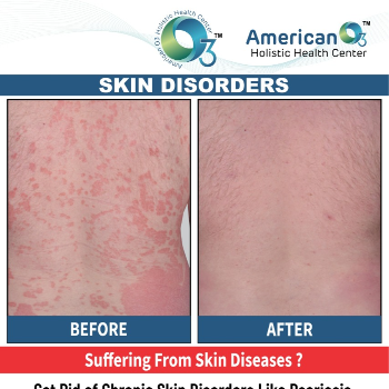 Skin Disorders Treatment | AMERICAN O3 HOLISTIC HEALTH CENTER | S - 8/9 SHREEJI SANKALP NR BACHPAN SCHOOL, 100 Feet Rd, Nanikhodiyar, Anand, Gujarat 388001, India