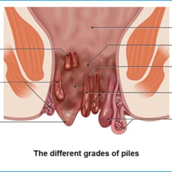 piles operation | JEET HOSPITAL | Kotla ,Dholpur, Rajasthan
