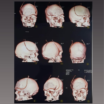 Traumatic Brain Injury Treatment in Shivajinagar, Pune | Brain And Spine Surgeon | Joshi Hospital , Maharashtra Medical Foundation , 778, Kamala Nehru Park Road , Opposite Kamala Nehru Park , Shivajinagar