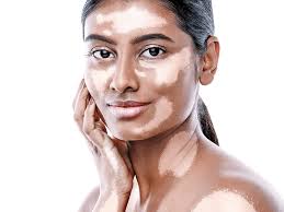 Vitiligo Treatment | Shree Lahri Poly Clinic Gondia | Avanti Chawk, Angur Bagija Rd, Near Nilesh Medical Stores, Gondia 441614