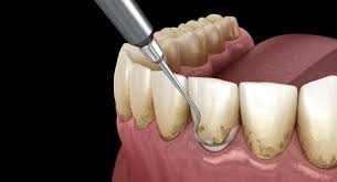 Restorative Procedures | Sun Dental Care | 323 Shighapore Town Ship Main Road Indore