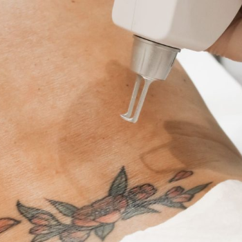 Tattoo Removal | Shree Lahri Poly Clinic Gondia | Avanti Chawk, Angur Bagija Rd, Near Nilesh Medical Stores, Gondia 441614