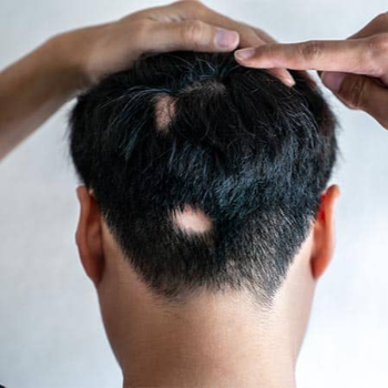 Alopecia | Shree Lahri Poly Clinic Gondia | Avanti Chawk, Angur Bagija Rd, Near Nilesh Medical Stores, Gondia 441614