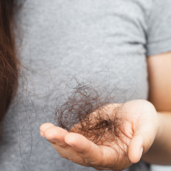 Hair Loss/Hair Fall | Shree Lahri Poly Clinic Gondia | Avanti Chawk, Angur Bagija Rd, Near Nilesh Medical Stores, Gondia 441614