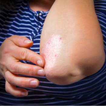 Psoriasis | Shree Lahri Poly Clinic Gondia | Avanti Chawk, Angur Bagija Rd, Near Nilesh Medical Stores, Gondia 441614