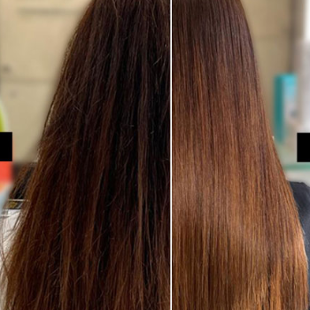 Botox | Shree Lahri Poly Clinic Gondia | Avanti Chawk, Angur Bagija Rd, Near Nilesh Medical Stores, Gondia 441614